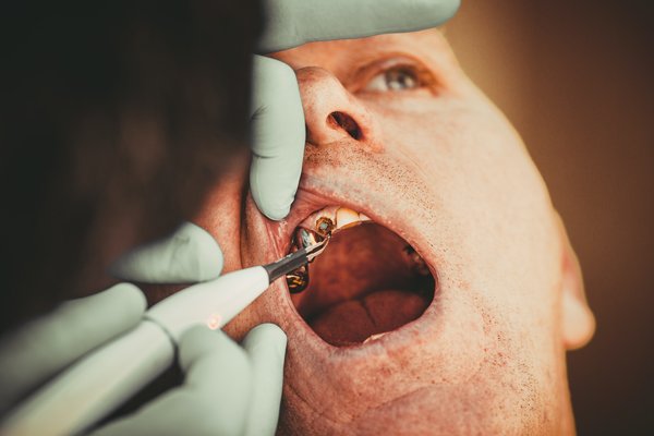Les secrets pour combattre les caries dentaires : causes, solutions et prévention efficaces